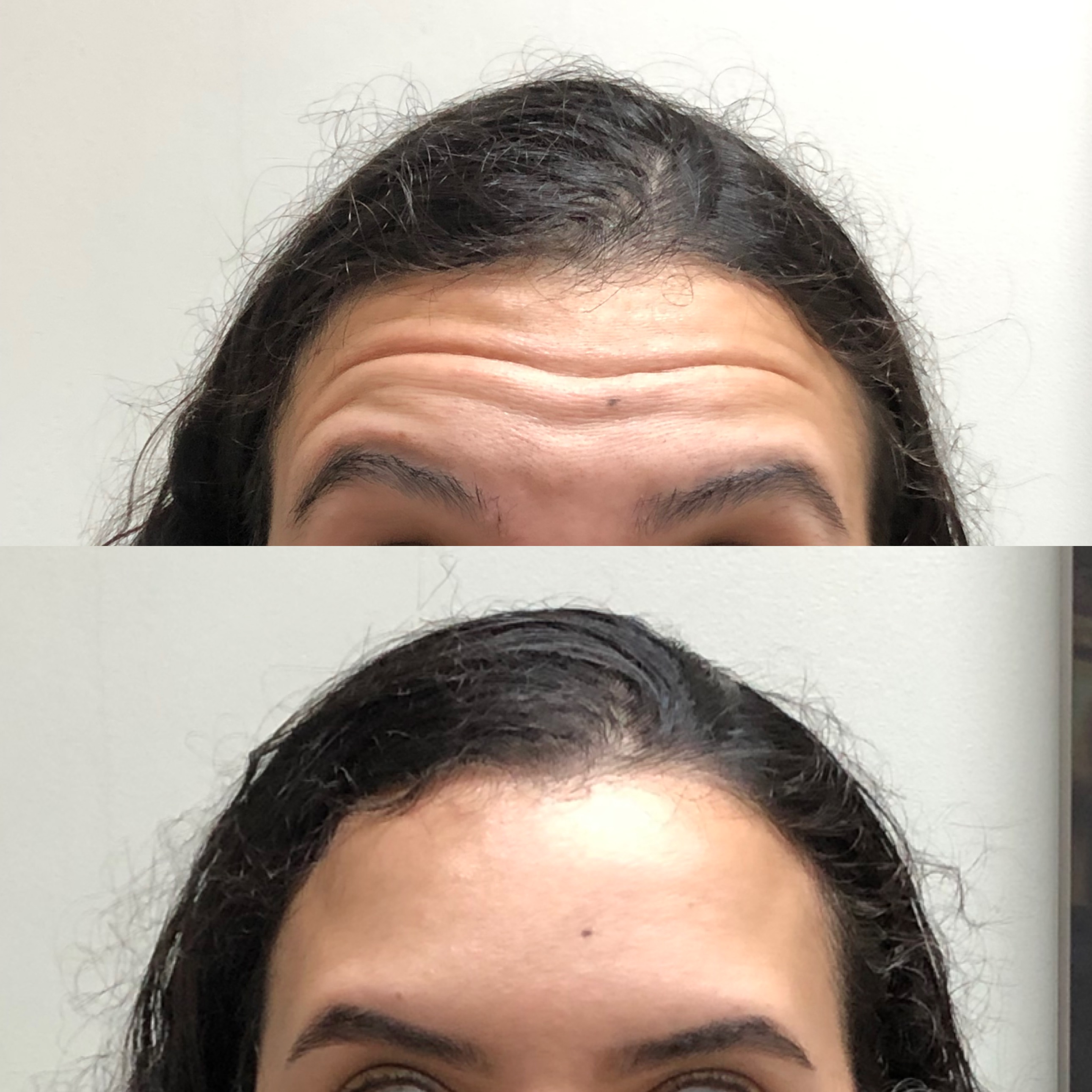 Botox Terço Superior