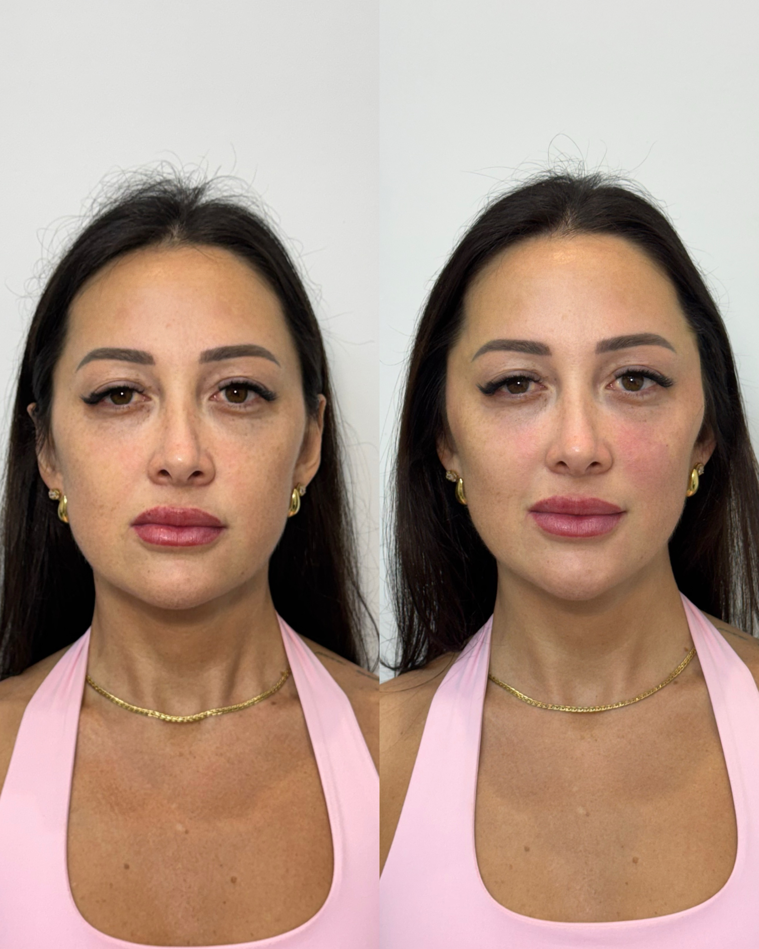 Harmonização Facial