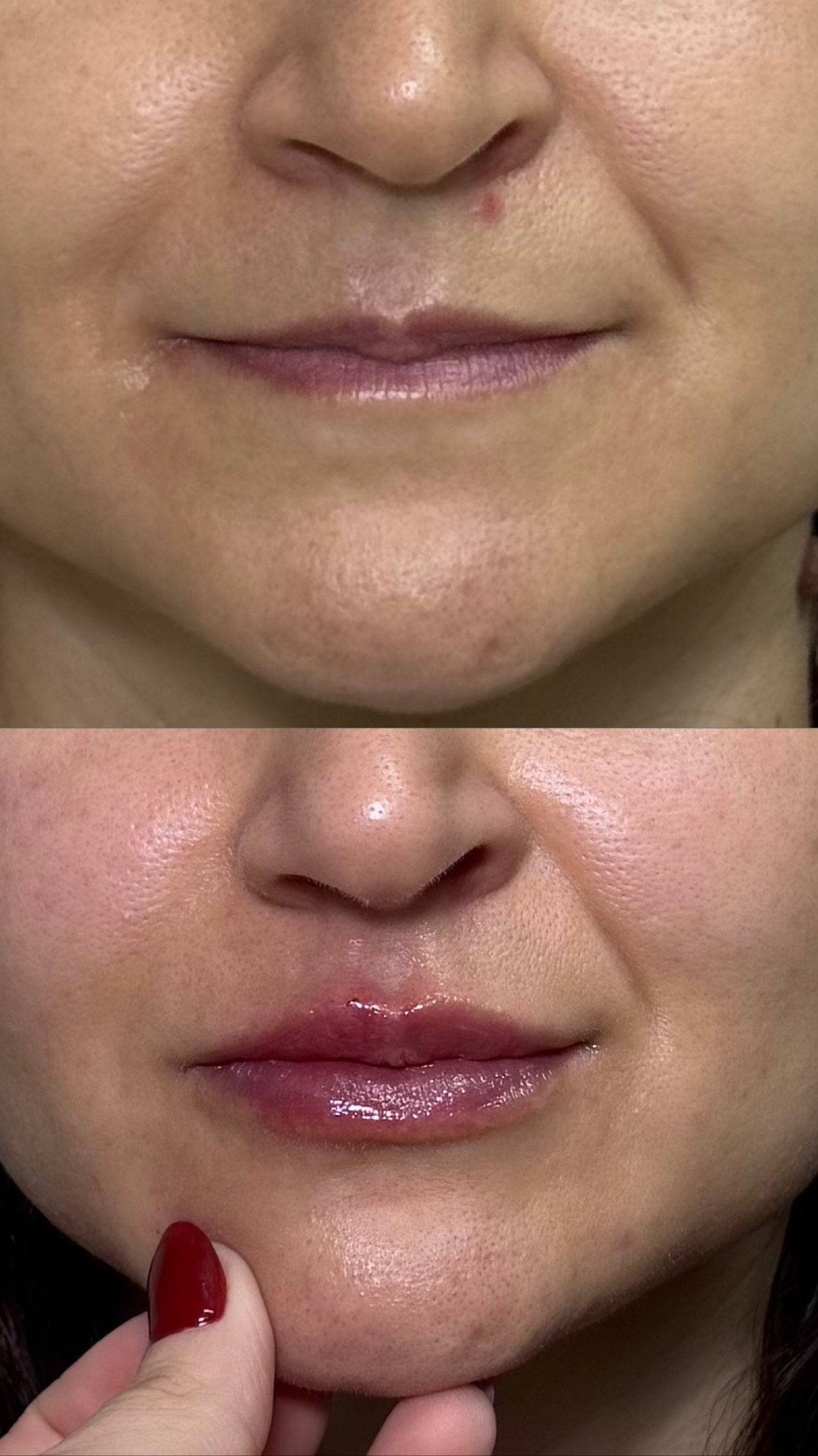 Preenchimento Labial