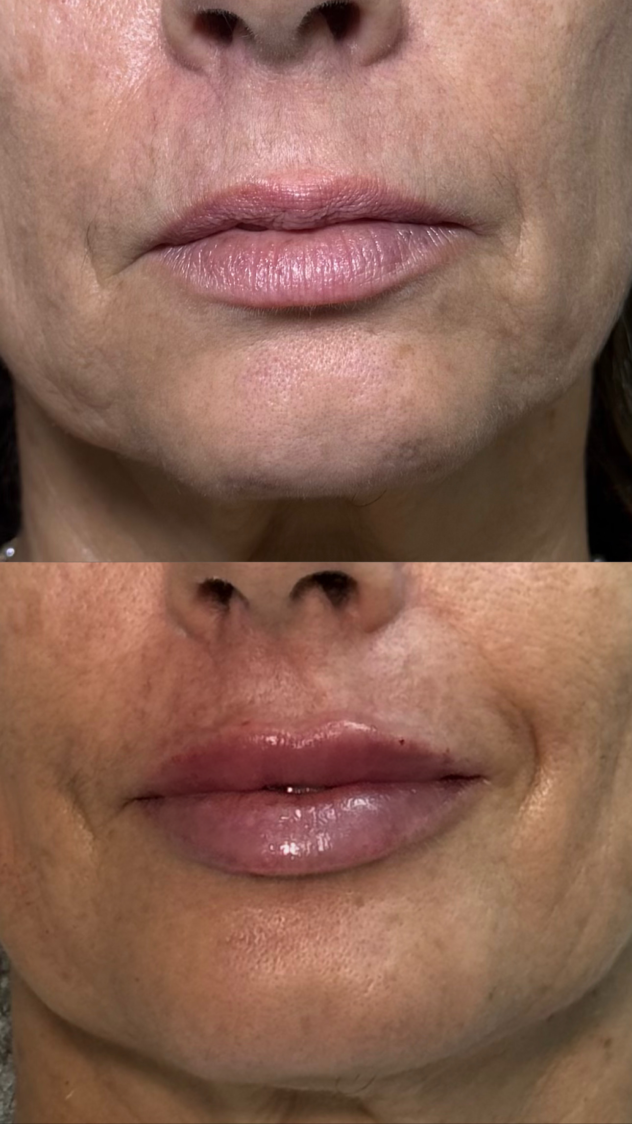 Preenchimento Labial