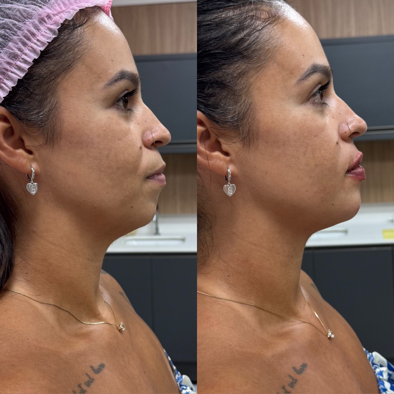 Perfiloplastia